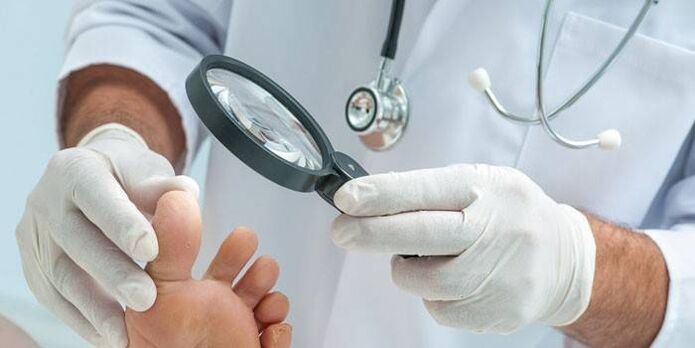 The doctor examines the wart on the foot