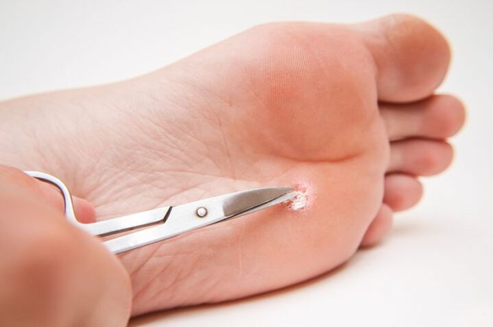 cutting the wart on the leg