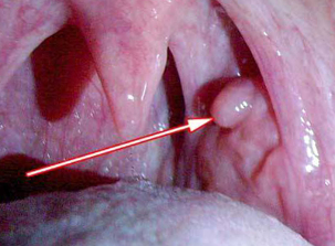 Papilloma of the throat