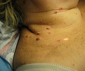 human papillomavirus in the neck