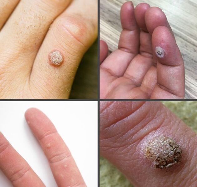 Common types of warts on fingers