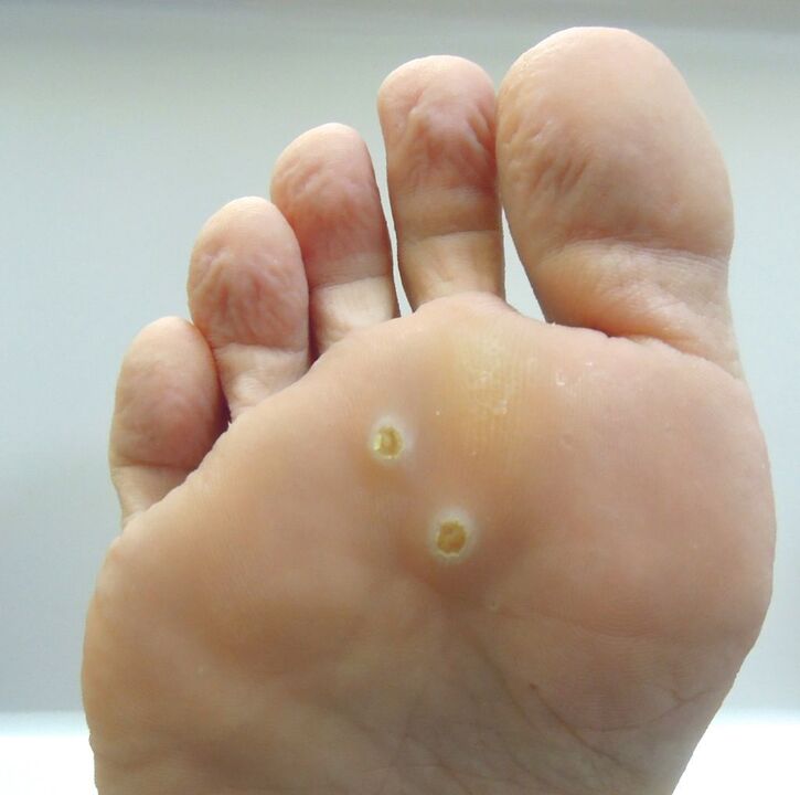 How to get rid of a foot wart
