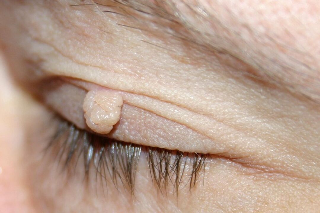 signs of papilloma on the eyelid