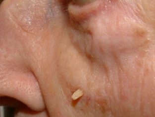 The appearance of warts