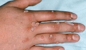 types of warts and methods of their removal